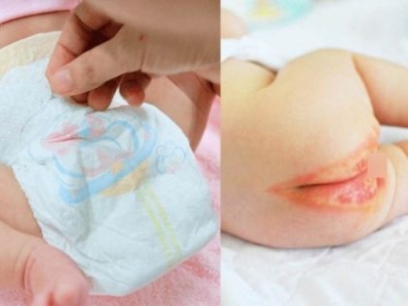 Bé Gái Bị Ngứa Vùng Kín Phải Làm Sao?