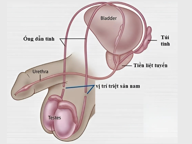 Thắt Ống Dẫn Tinh Là Gì?