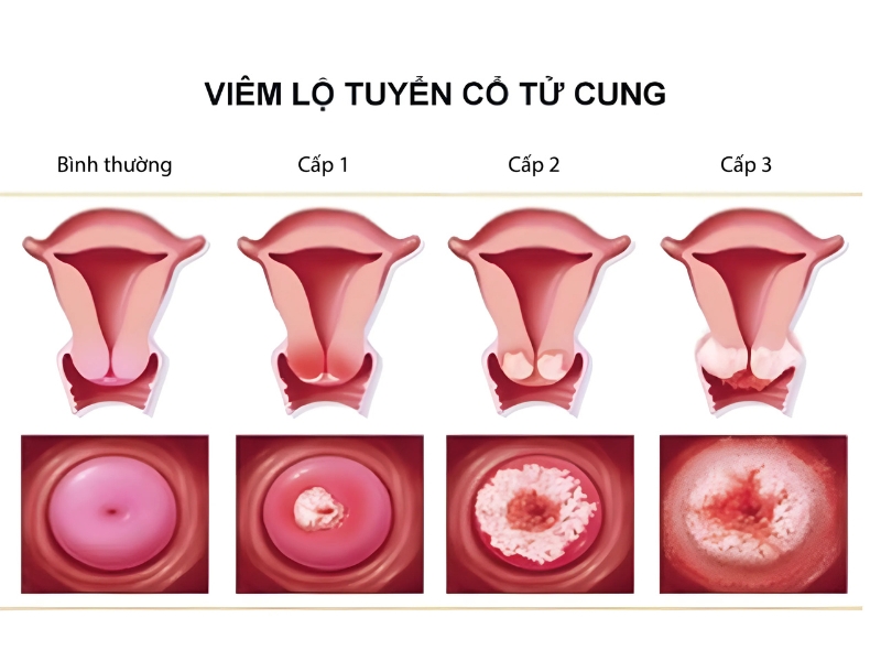 Cách Điều Trị Viêm Lộ Tuyến Cổ Tử Cung Hiệu Quả