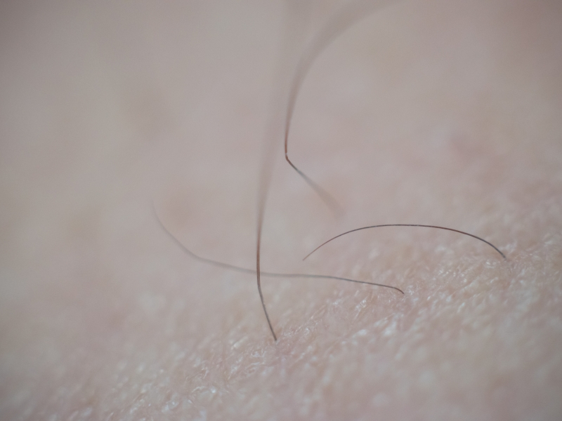 Ngứa Lông Mu Và Cách Điều Trị Tại Nhà Hiệu Quả