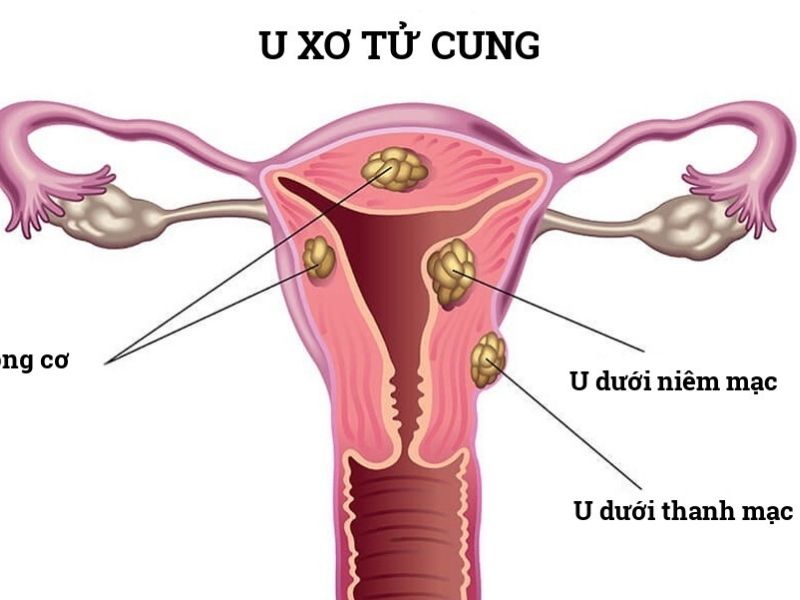 Quan hệ bị đau bụng dưới