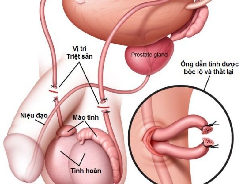 Triệt Sản