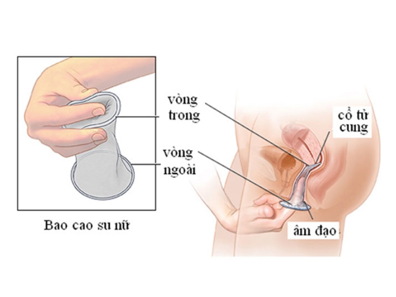 Những lưu ý khi sử dụng bao cao su nữ