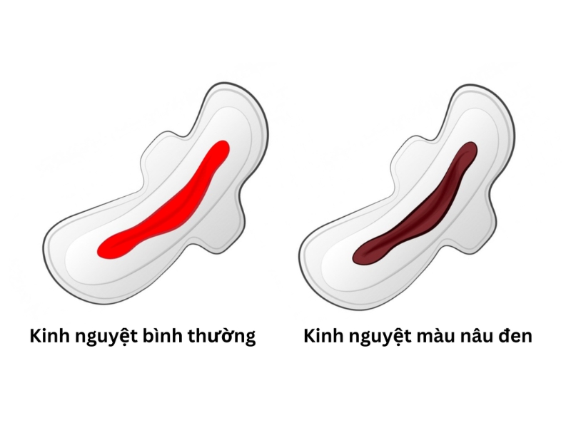 Sự khác nhau giữa kinh nguyệt bình thường và bất thường